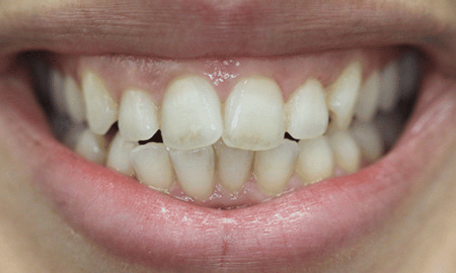 Before - Olive Tree Dental